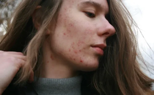 Person's acne