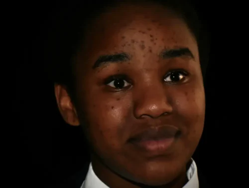 Person's hyper-pigmentation